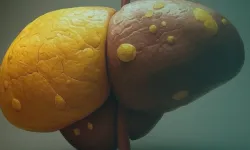 Печень с гепатозом